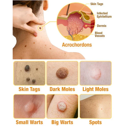 Skin Tag & Wart Removal Spray with Natural Bee Venom Extract for Blemish-Free Complexion at Home Treatment