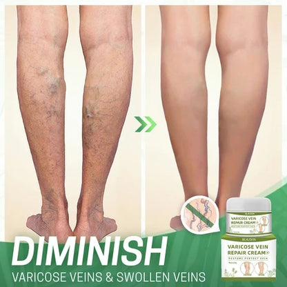 Varicose Vein Cream Reduces Spider Veins Natural & Moisturizing