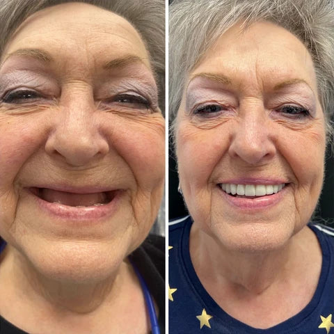 Silicone Denture Kit for Confident All-Day Smiling Without Slipping or Pain