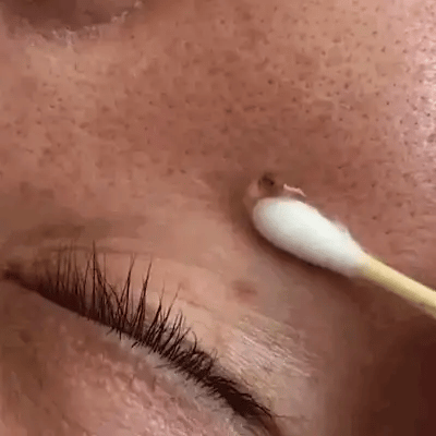 Blemish Cream Mole & Wart Remover Painless Scar-Free