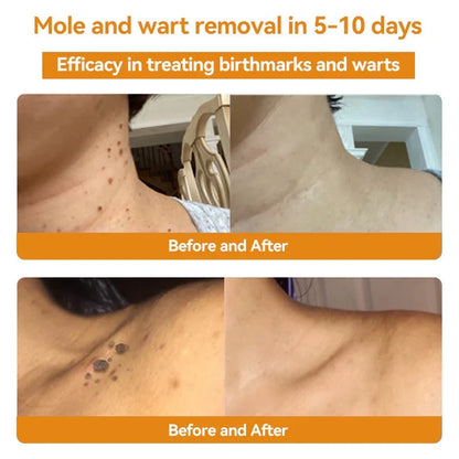 Skin Tag & Wart Removal Spray with Natural Bee Venom Extract for Blemish-Free Complexion at Home Treatment
