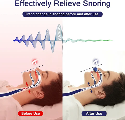 Portable Sleep Apnea Relief Device Anti-Snoring Nasal Airway Support System for Travel Home Bedroom USB Rechargeable Silicone Soft Ear Clips