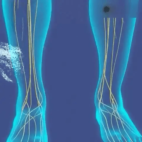 Topical Spray Cooling Joint & Vein Relief