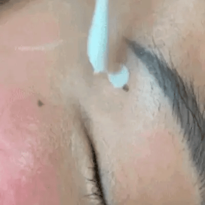 Blemish Cream Mole & Wart Remover Painless Scar-Free