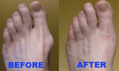 Bunion Corrector Adjustable Night Splint Set of 8
