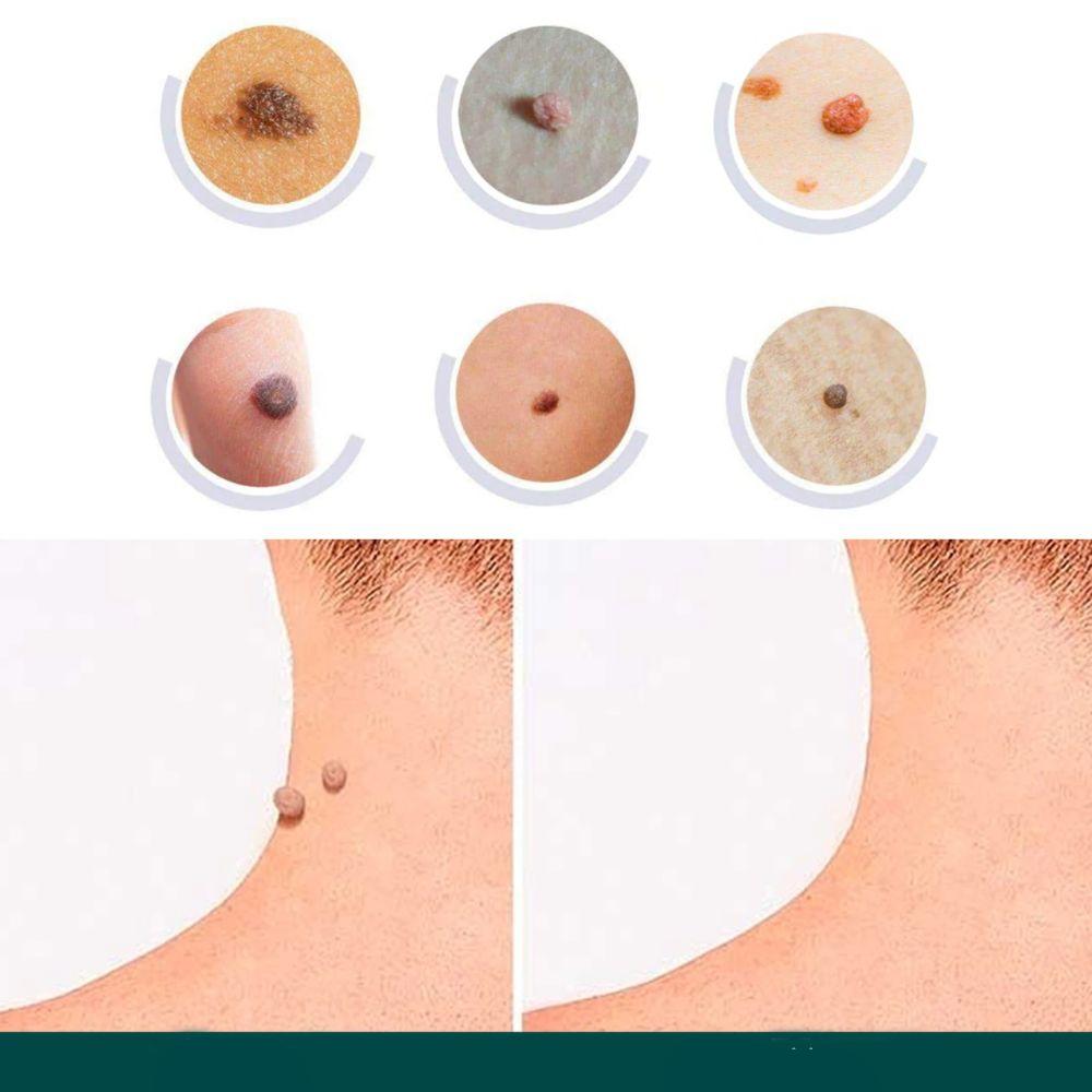 Skin Care Treatment Patches for Wart and Spot Removal