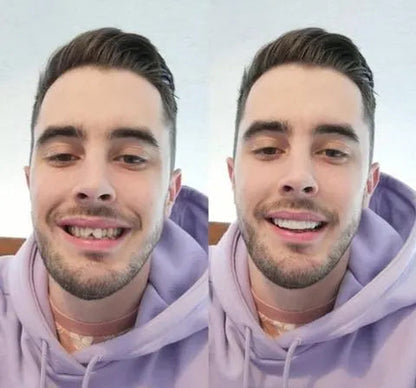 Smile Transformation | Removable Veneers Set for Natural Look & Comfort | Perfect Solution for Your Smile
