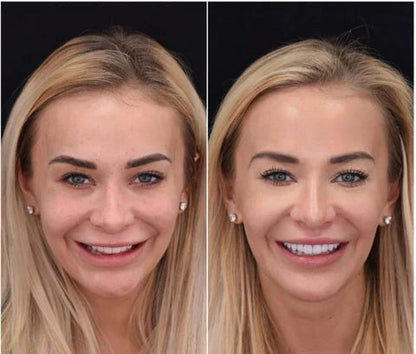 Snap On Veneers for Upper and Lower Teeth, Moldable Custom Fit Removable Teeth Veneers, Cosmetic Fake Teeth Cover