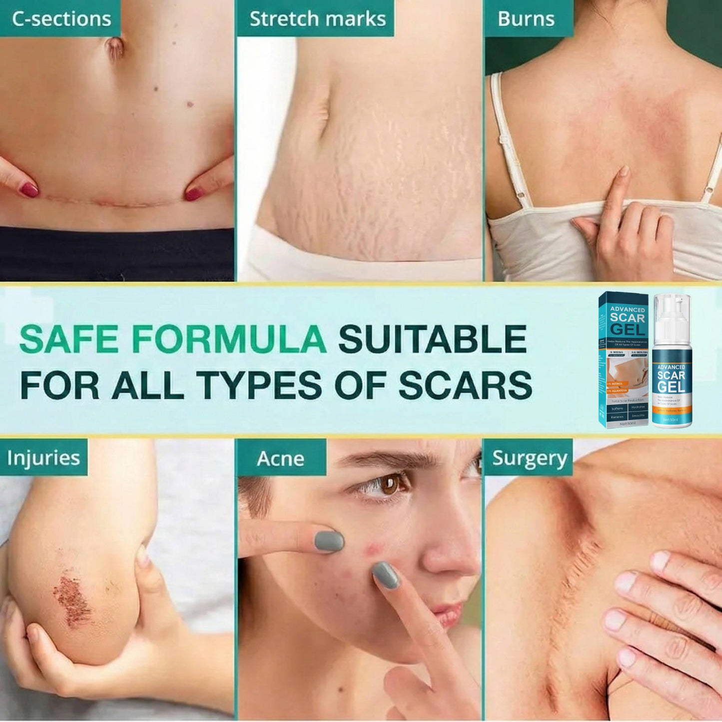 Silicone Scar Removal Cream for Fade Marks and Stretch Marks