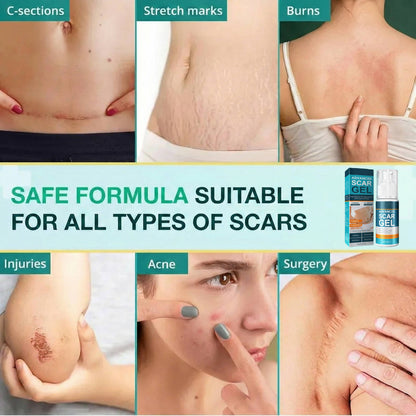 Silicone Scar Removal Cream for Fade Marks and Stretch Marks