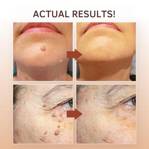 Precision Skin Tag & Wart Removal Pen with Botanical Extract Formula for At-Home Spot Treatment