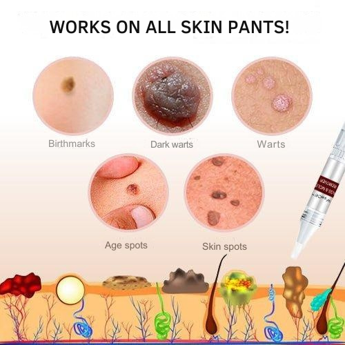 Precision Skin Tag & Wart Removal Pen with Botanical Extract Formula for At-Home Spot Treatment