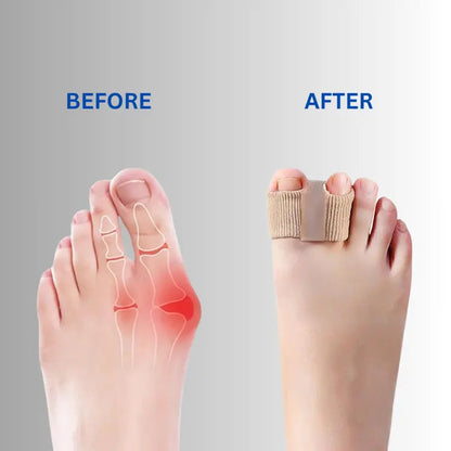 Soft Silicone Toe Spacers for Bunion Relief & Overlap Correction – Comfortable Alignment Pads for Walking, Running & Recovery