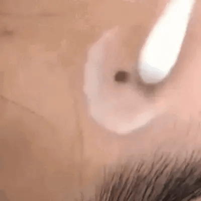 Skin Tag & Mole Remover Cream Fast-Acting Painless Scar-Free