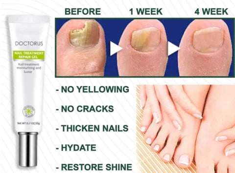 Toenail Gel Antifungal Hydrating 15ml