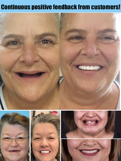 Moldable Cosmetic Denture Set Upper & Lower – Heat-Fit Natural White Teeth for Everyday Confidence