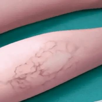 Varicose Vein Cream Herbal & Cooling Reduces Swelling