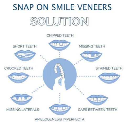 Easy Fit Clip On Smile Veneers Upper Lower Teeth