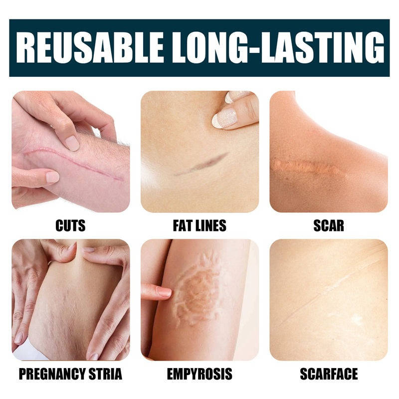 Silicone Scar Removal Cream for Fade Marks and Stretch Marks