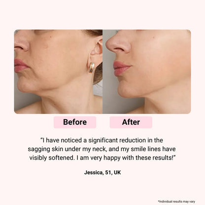 LED Light Therapy Face Mask for Anti-Aging, Acne & Skin Rejuvenation – Professional Multi-Color Photon Treatment System with Remote