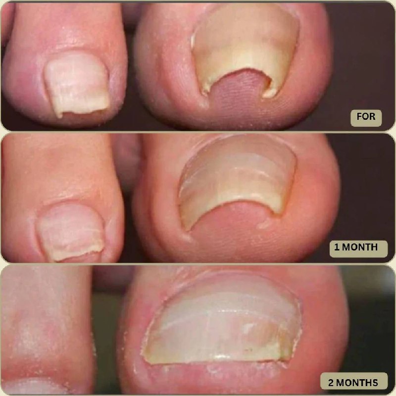Fast Nail Fix for Broken and Ingrown Nails